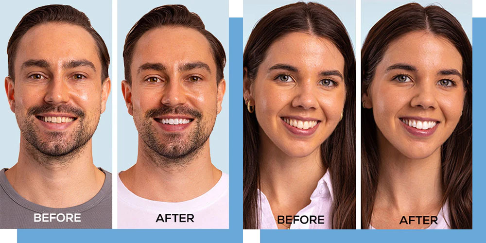 Teeth Whitening Upper East Side