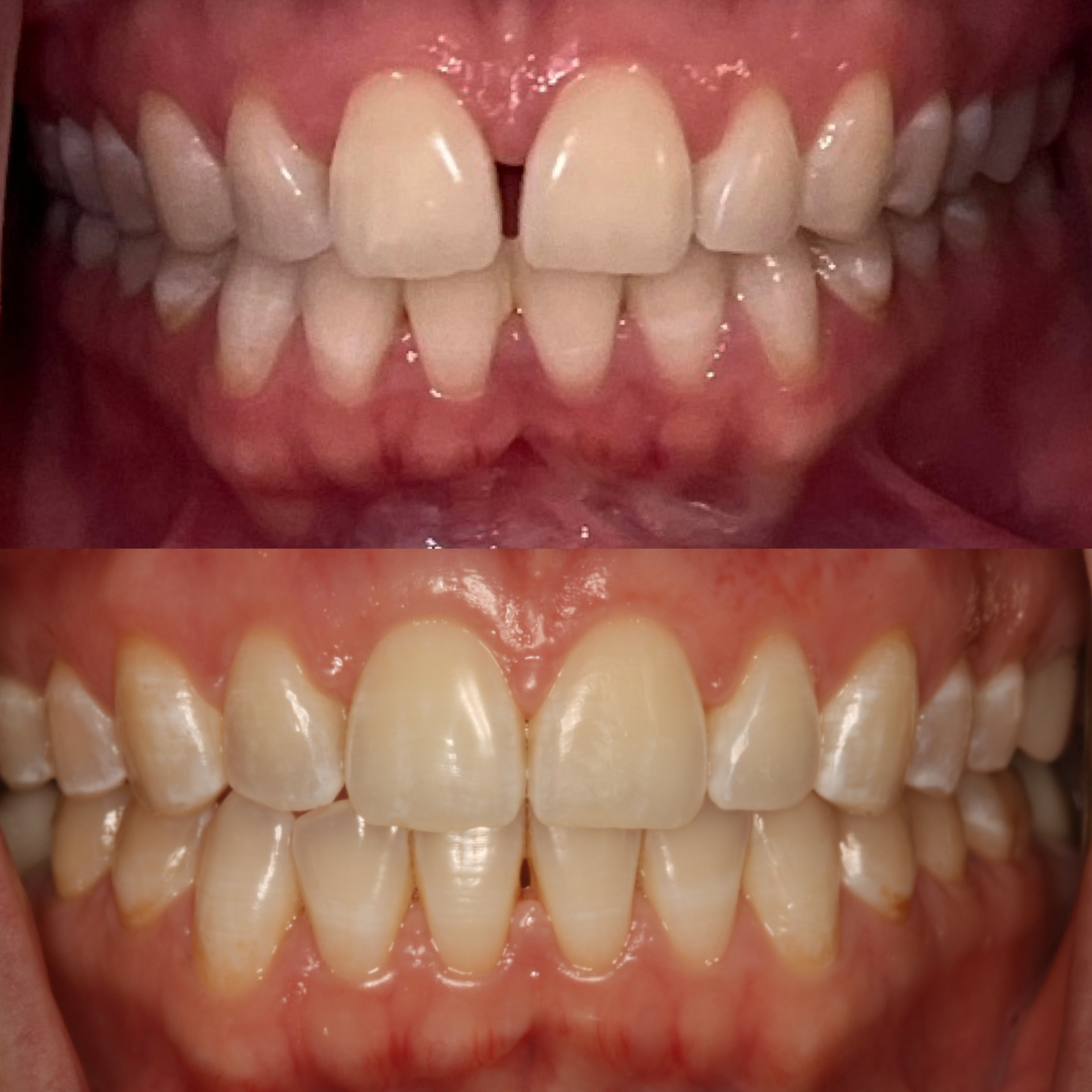 INVISALIGN dentist upper east side