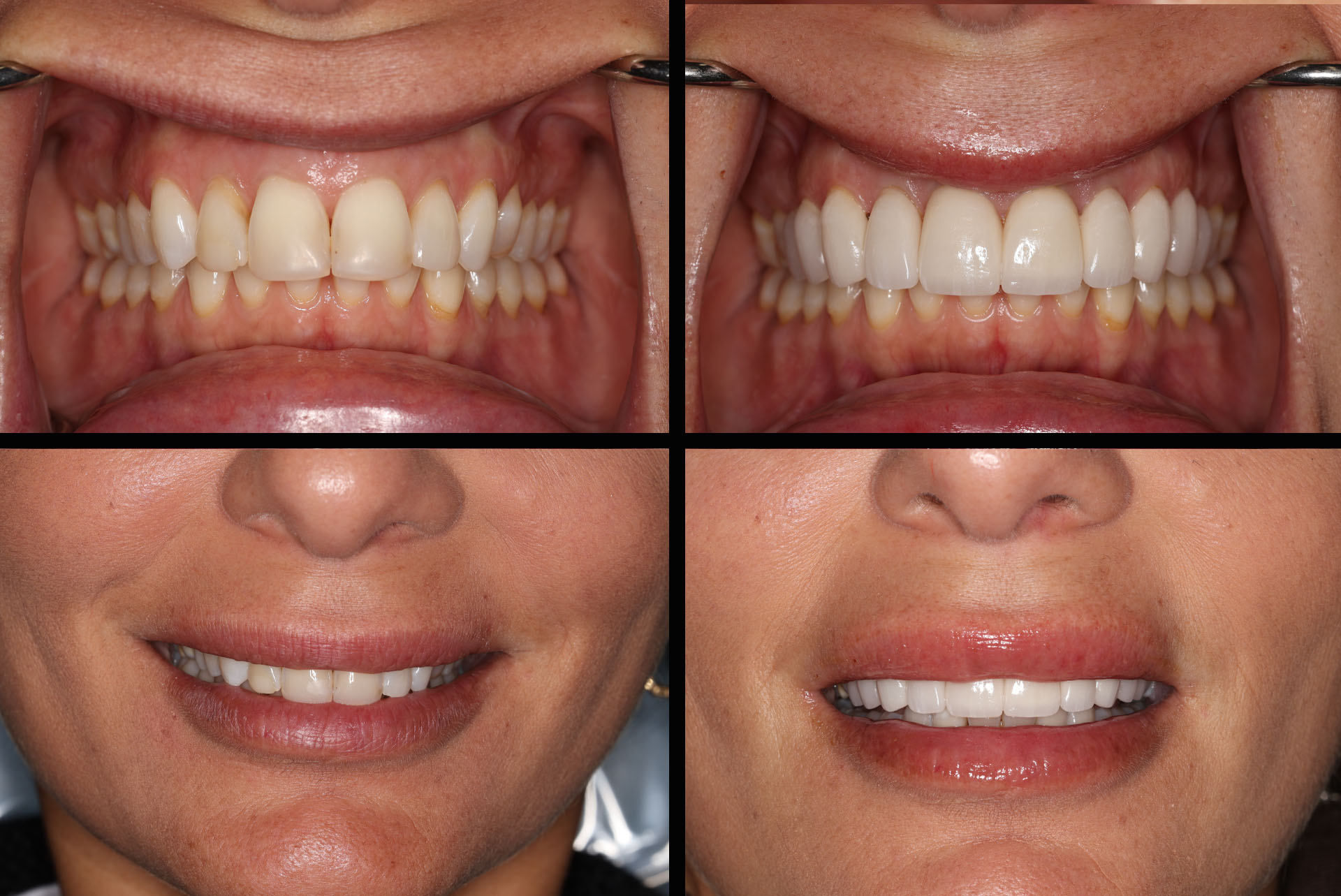 Smile Makeover Upper East Side