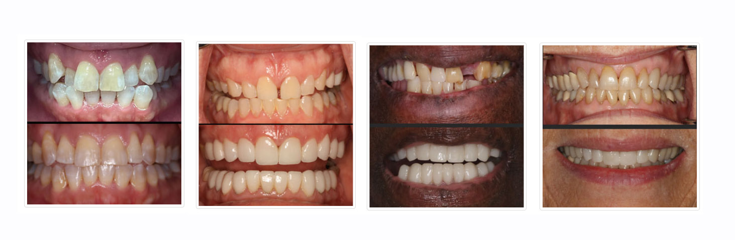 Before After Veneers NYC