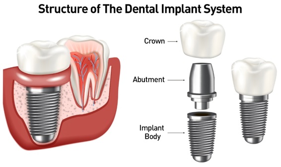 dental-implants-upper-east-side