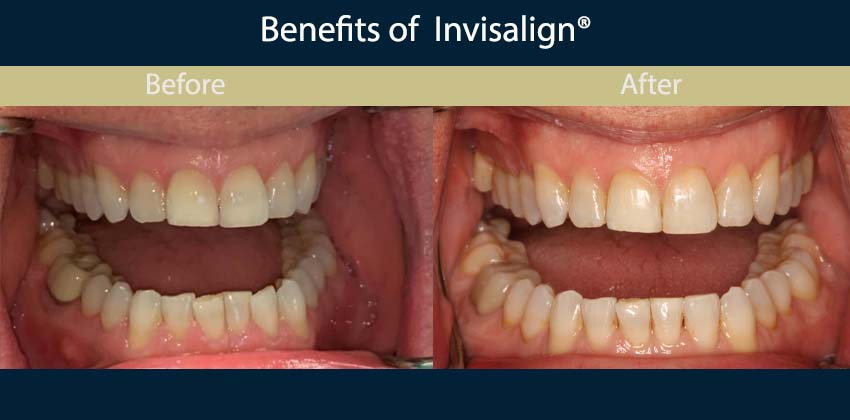 Invisalign After Braces in NYC - Cosmetic, General and Pediatric Dentistry  located in the heart of NYC.