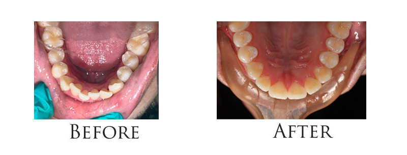invisalign-before-after-nyc