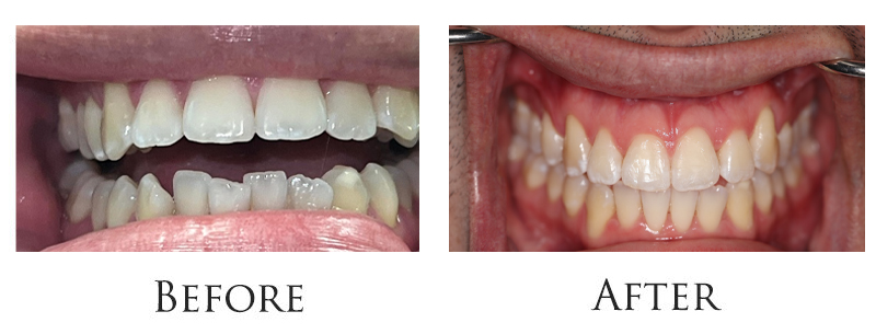 invisalign-treatment-nyc