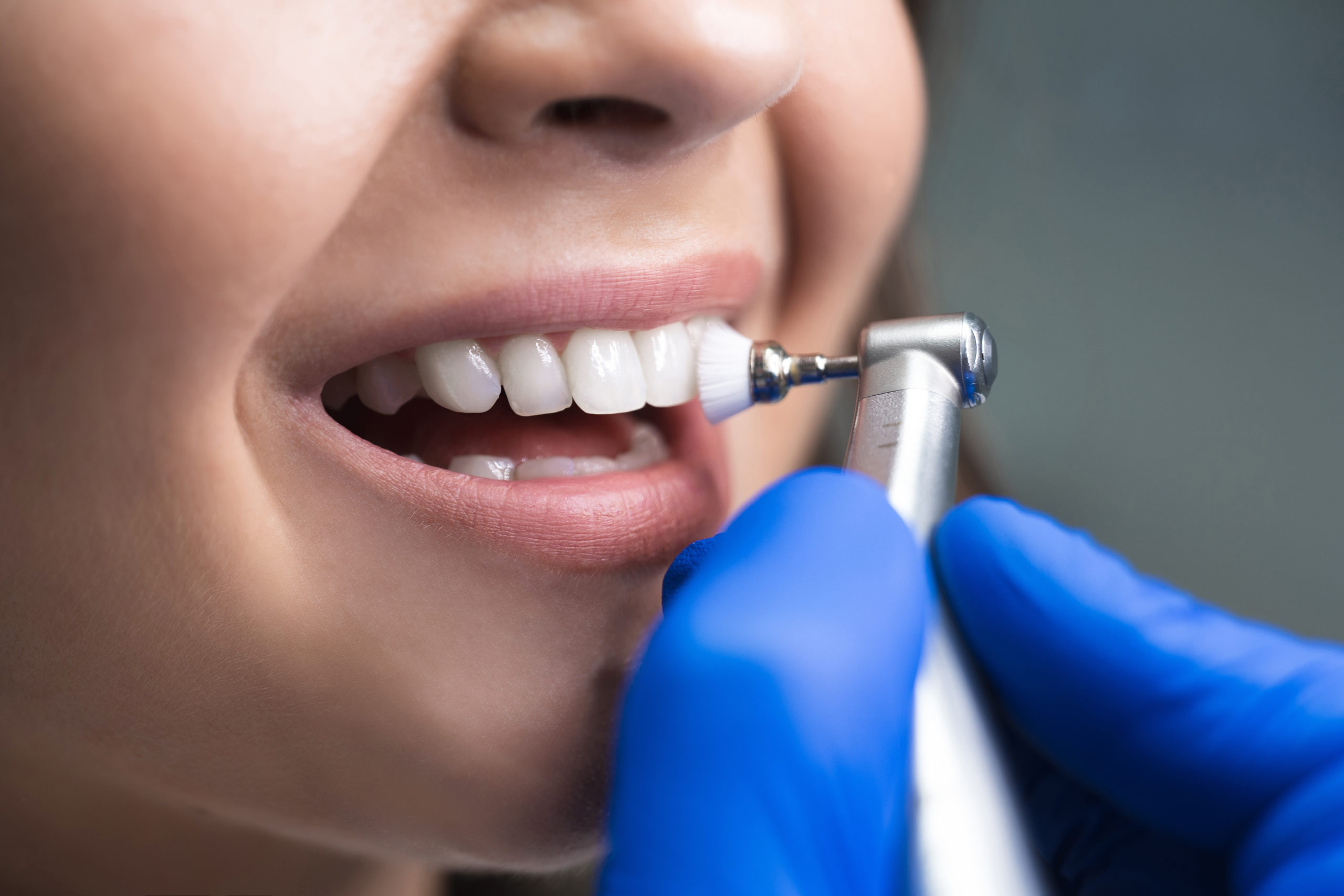 Teeth Cleaning Upper East Side